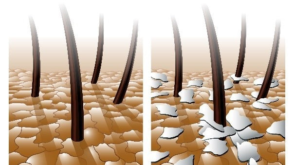 Les pellicules grasses