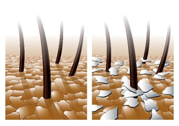 Les pellicules grasses